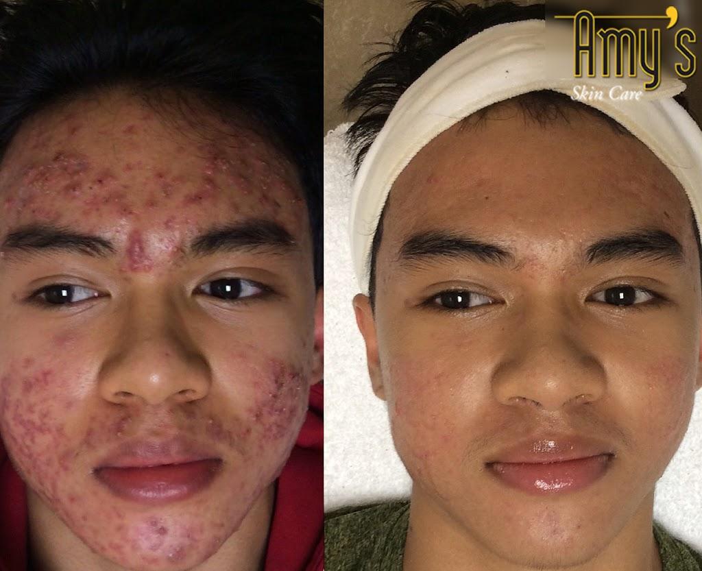 Acne Treatment Houston Amy S Skincare And Med Spa
